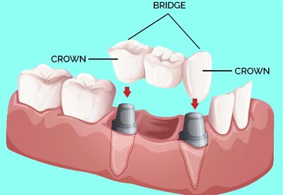 Dental-Bridge-and-Crown