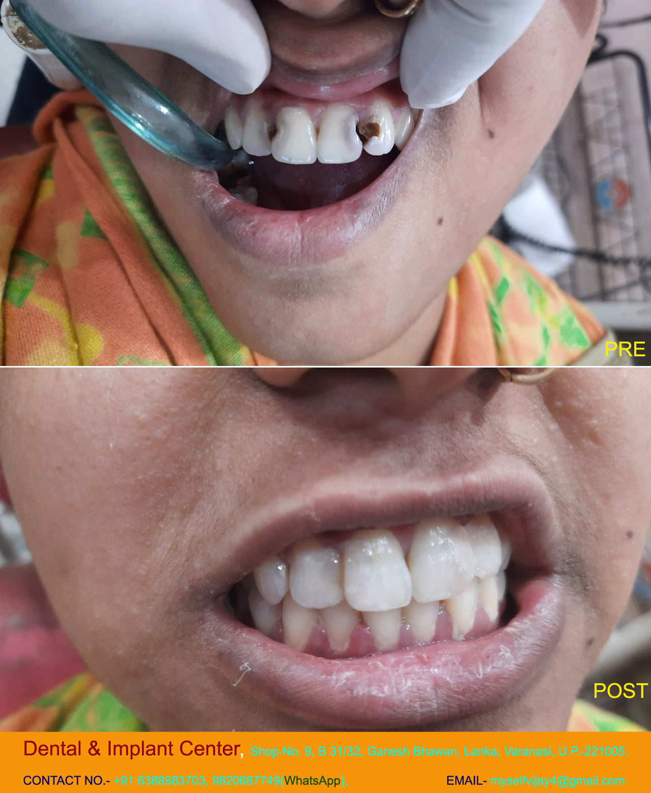 Dr Vijay Rai | Dental & Implant Center, Lanka Varanasi | Operated Cases 1 