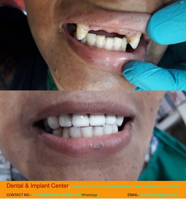 Dental & Implant Center, Lanka Varanasi | Operated Cases 10 