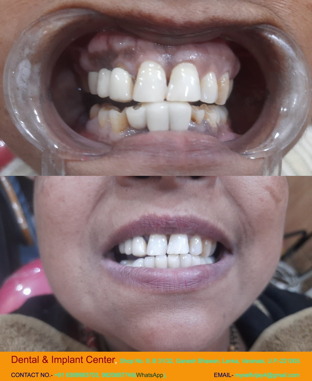 Dental & Implant Center, Lanka Varanasi | Operated Cases 12 