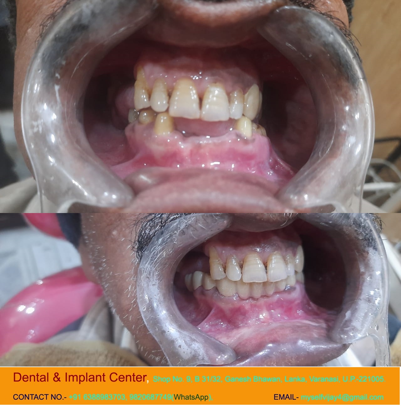 Dental & Implant Center, Lanka Varanasi | Operated Cases 13 