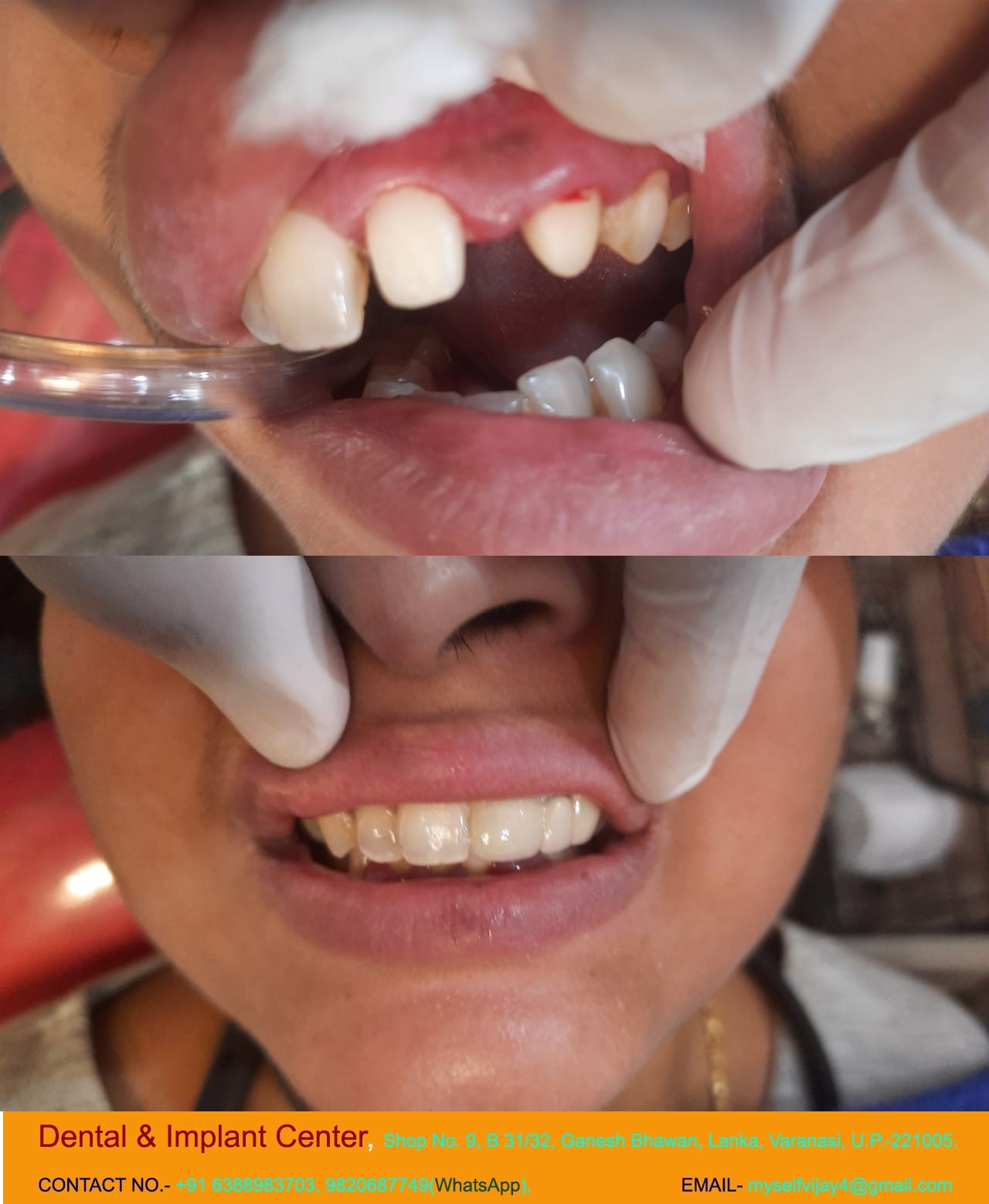 Dental & Implant Center, Lanka Varanasi | Operated Cases 14 