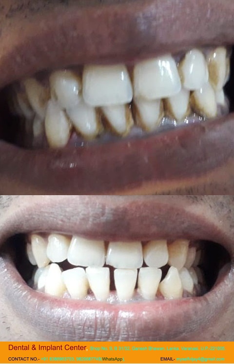 Dental & Implant Center, Lanka Varanasi | Operated Cases 16 