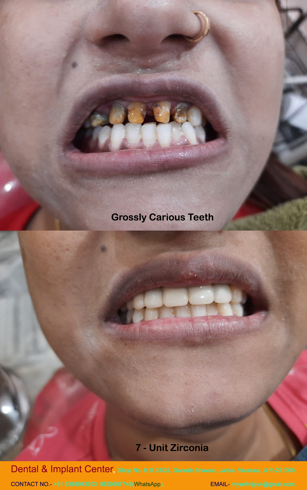 Dental & Implant Center, Lanka Varanasi | Operated Cases 4 