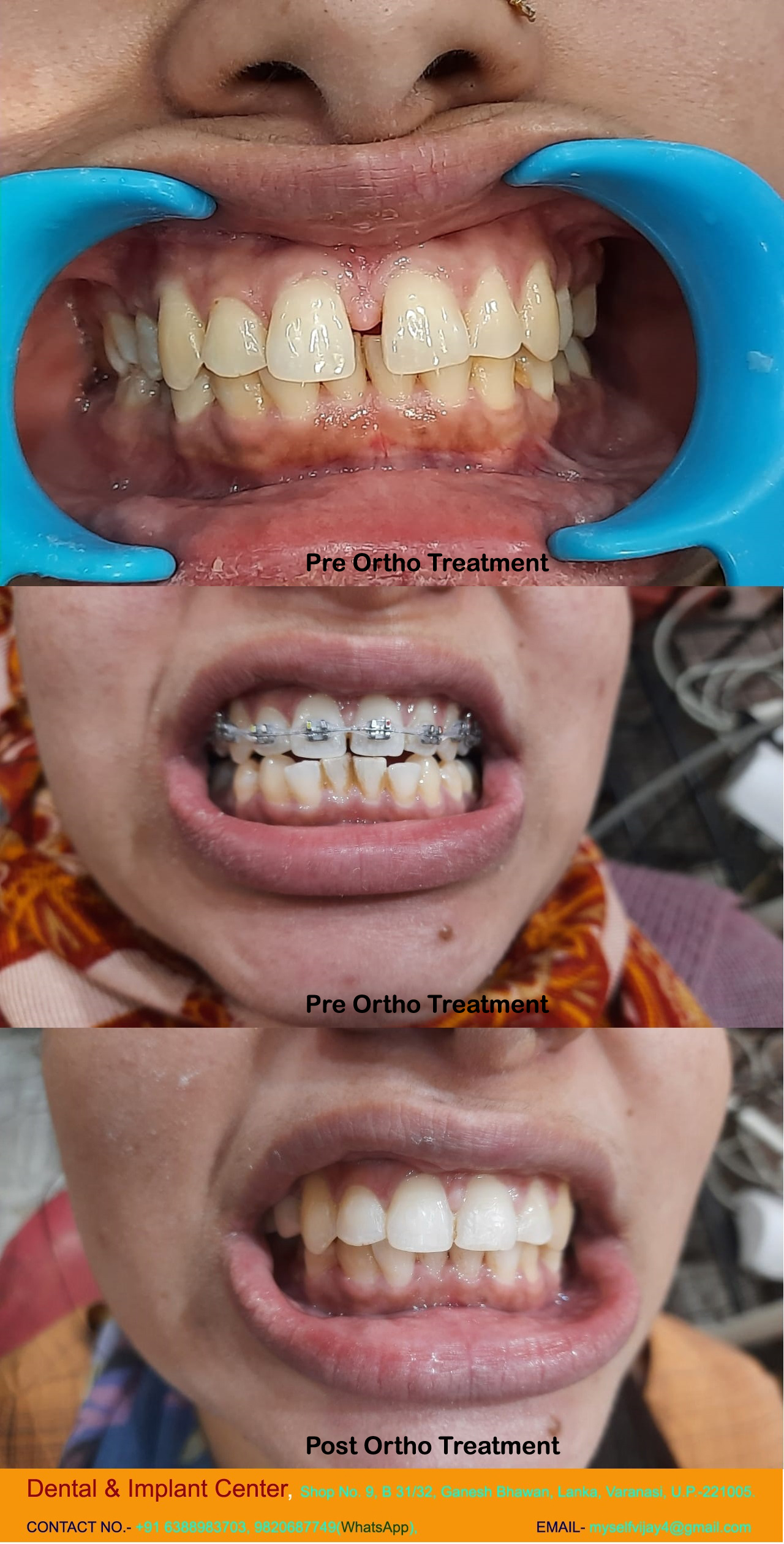 Dental & Implant Center, Lanka Varanasi | Operated Cases 5 