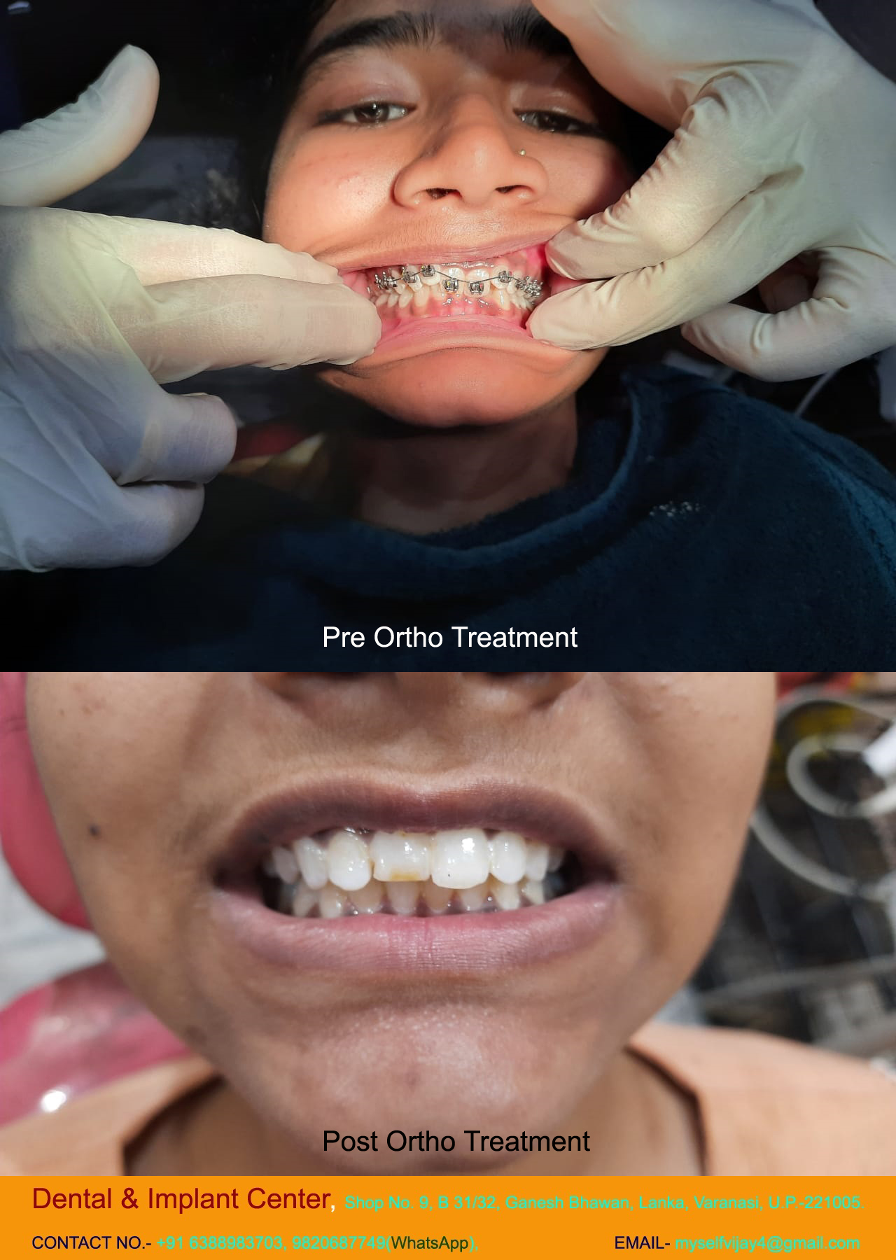 Dental & Implant Center, Lanka Varanasi | Operated Cases 6 