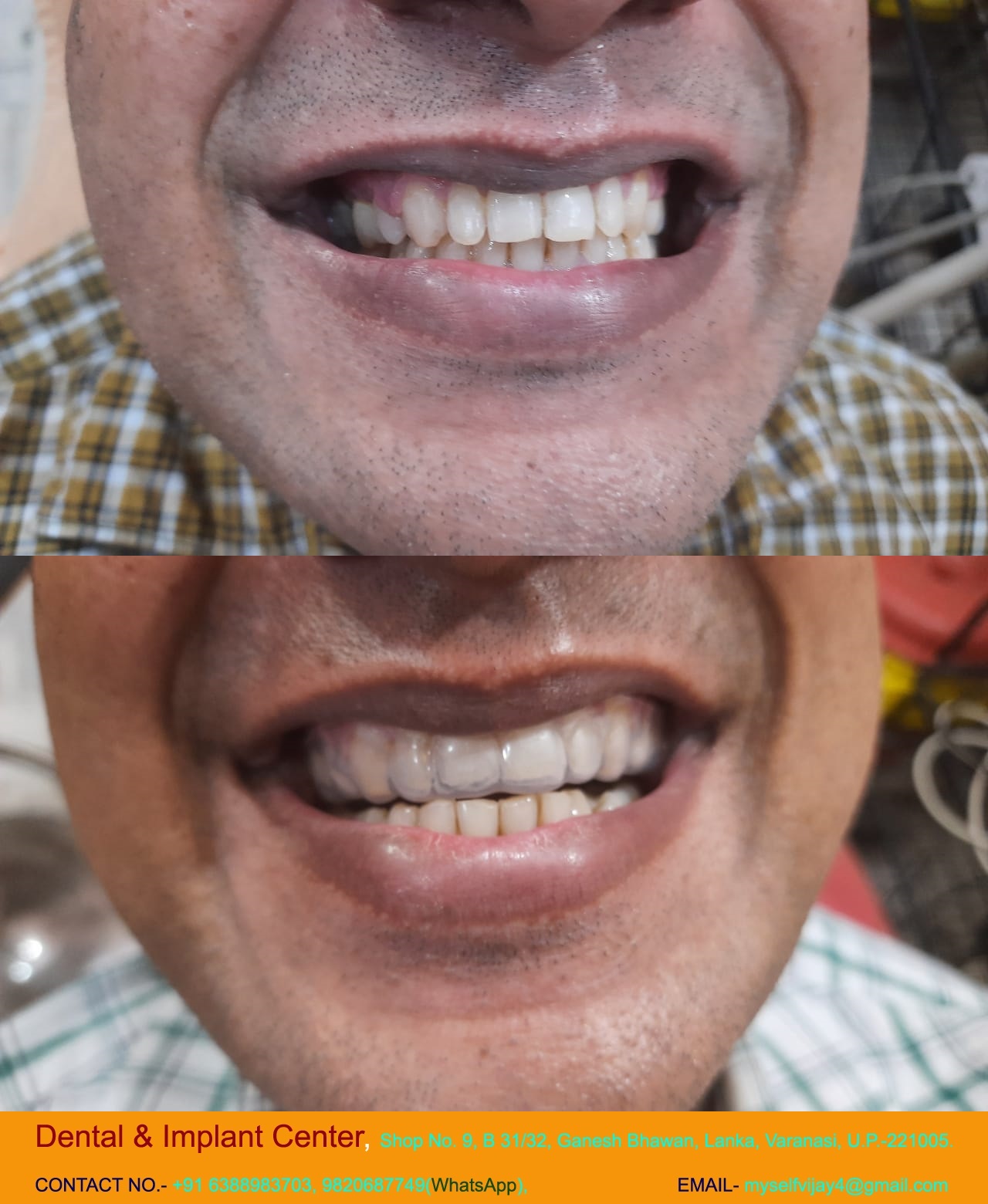 Dental & Implant Center, Lanka Varanasi | Operated Cases 7 
