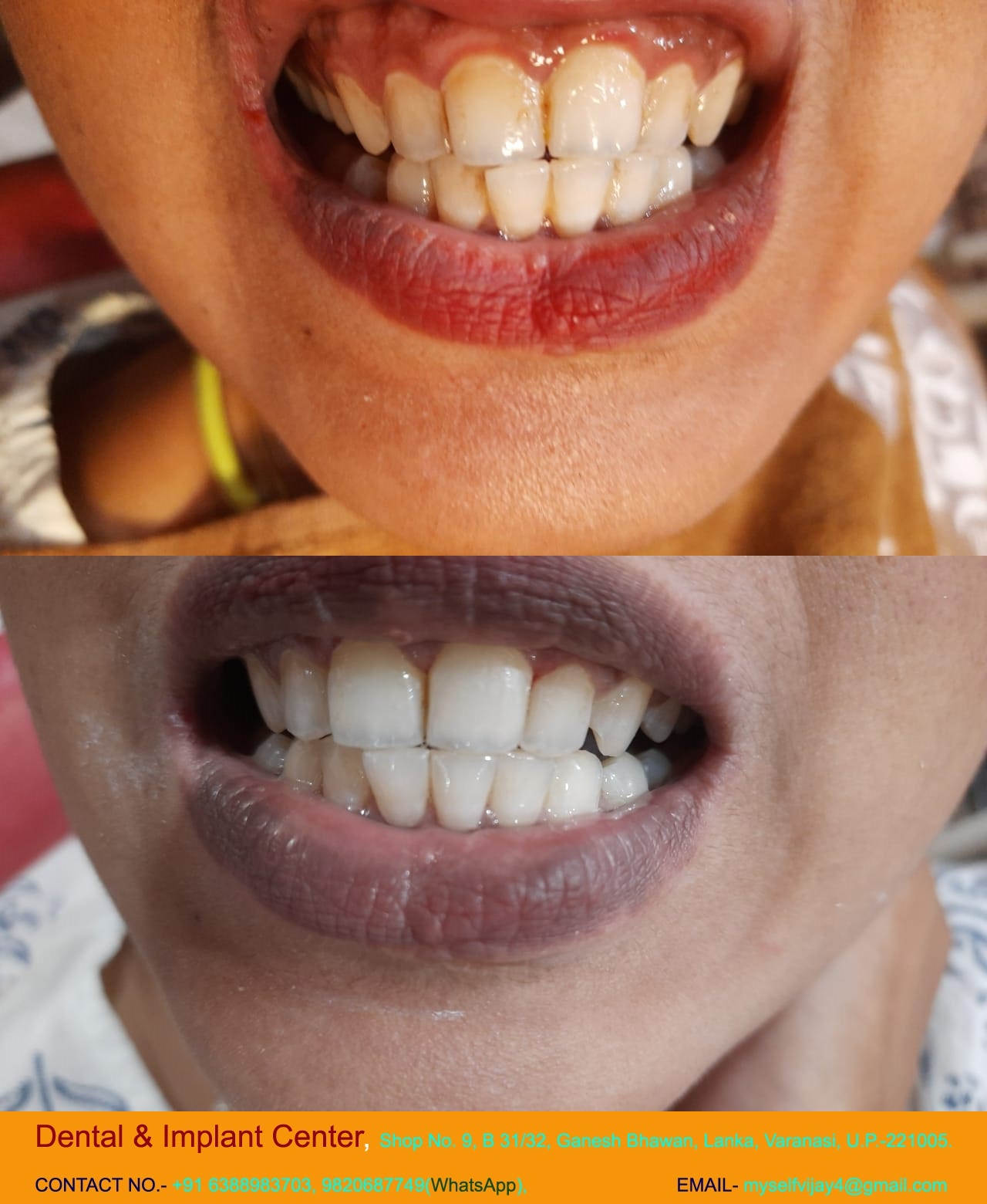 Dental & Implant Center, Lanka Varanasi | Operated Cases 9 