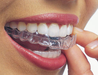 Invisalign