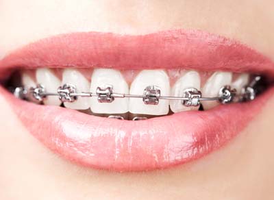 Metal_braces