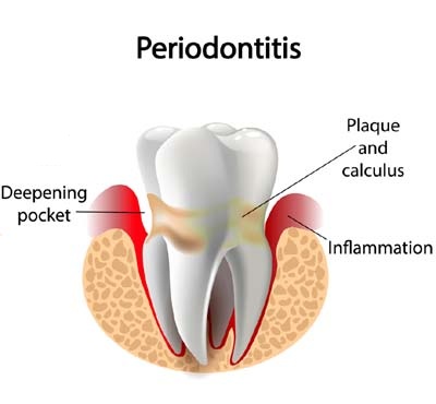 Periodontitis