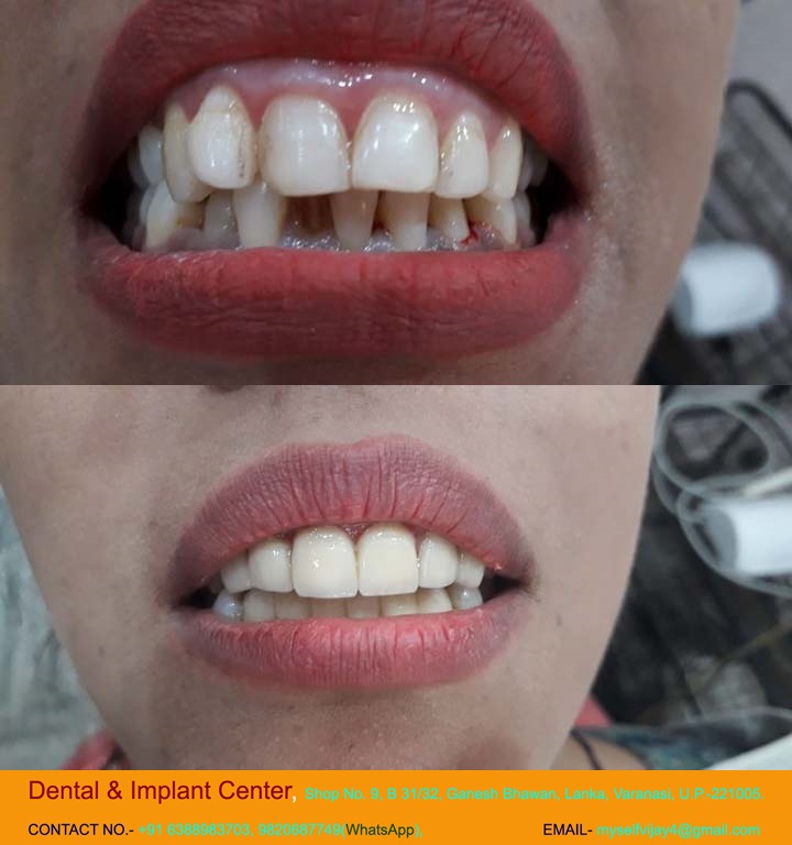 Dental & Implant Center, Lanka Varanasi | Operated Cases 11 