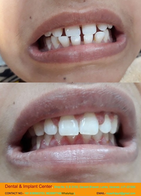 Dental & Implant Center, Lanka Varanasi | Operated Cases 15 