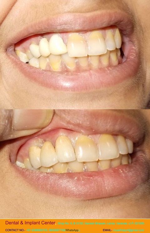 Dental & Implant Center, Lanka Varanasi | Operated Cases 17 