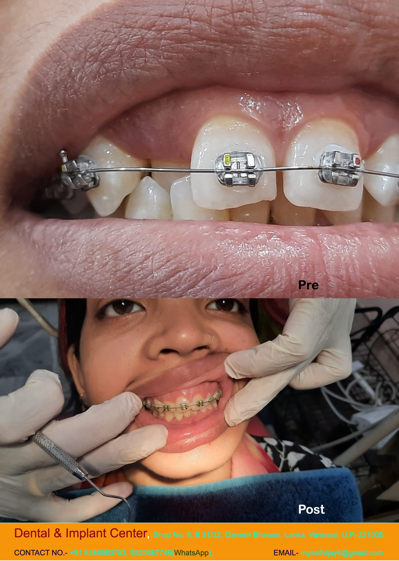 Dental & Implant Center, Lanka Varanasi | Operated Cases 2 