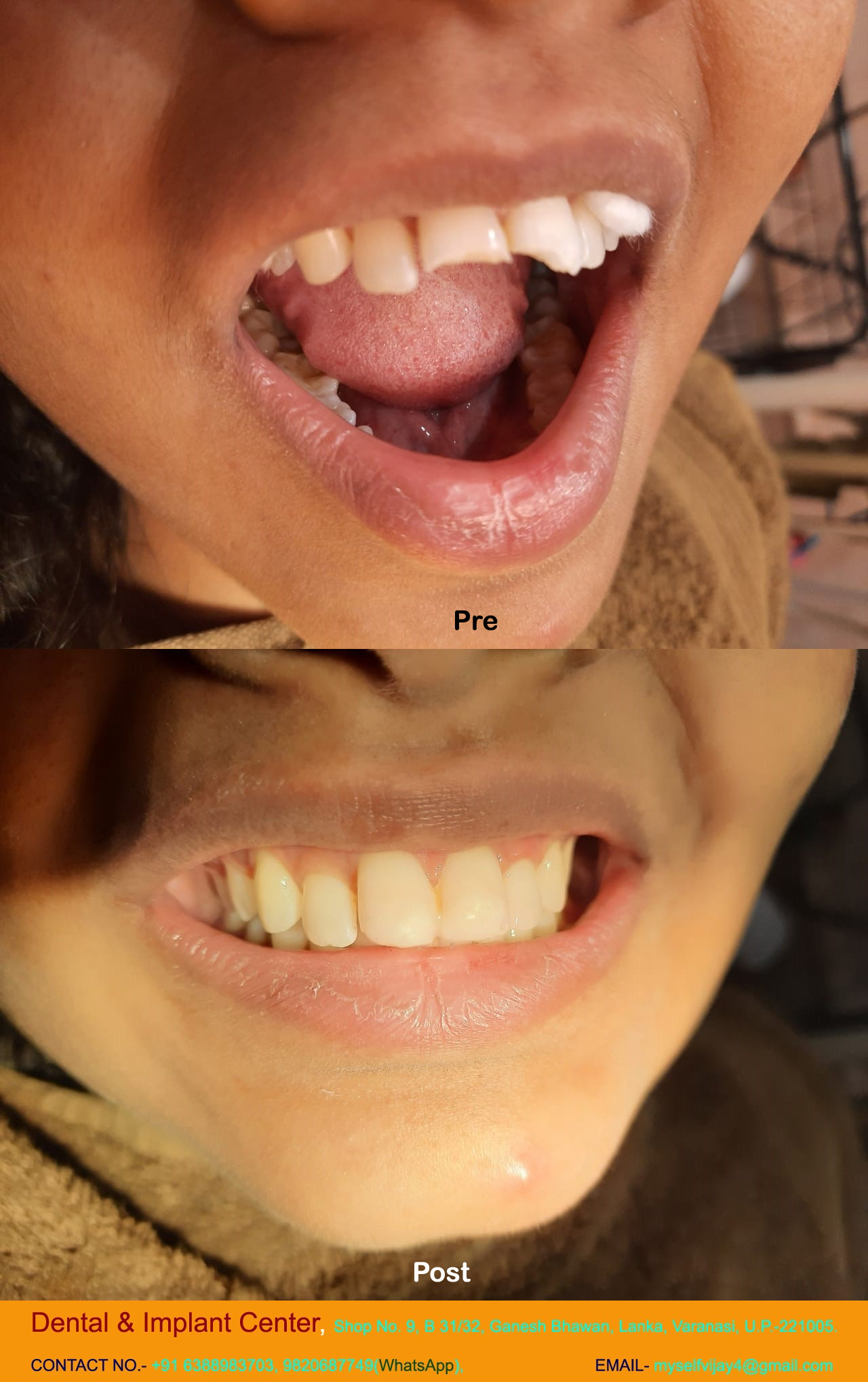 Dental & Implant Center, Lanka Varanasi | Operated Cases 3 