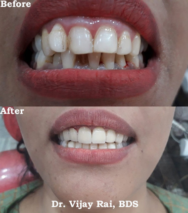 Dental & Implant Center, Lanka Varanasi | Operated Cases 18 