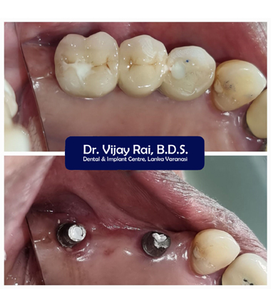 Dental & Implant Center, Lanka Varanasi | Operated Cases 22 