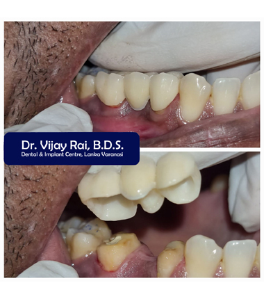 Dental & Implant Center, Lanka Varanasi | Operated Cases 24 