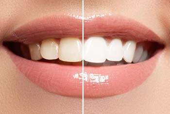 TeethWhitening