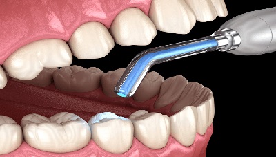 Conservative Dentistry