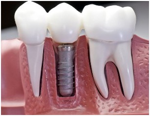 dental implant