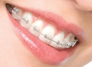 Jaw (Dental) wiring